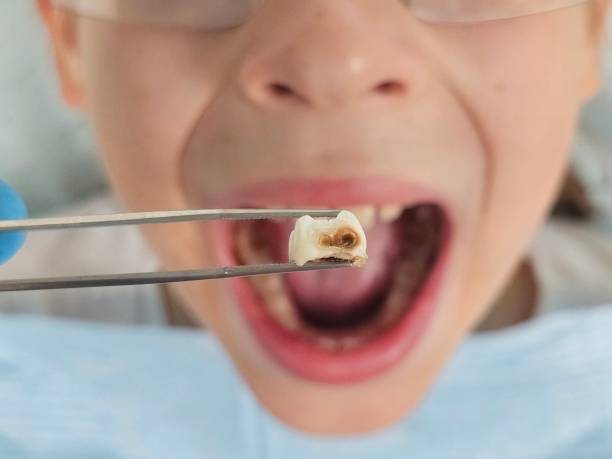 Best Emergency Tooth Extraction in Brodhead, WI